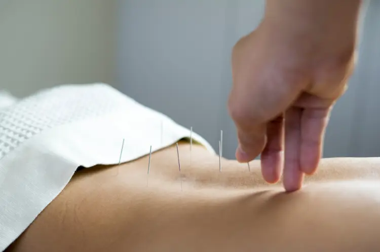 Akupunktur gegen Gelenkschmerzen